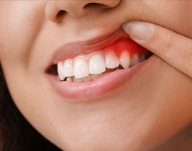Dental Abscess