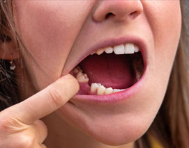 Knocked Out Tooth